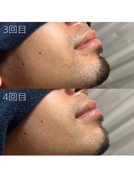 カナウ(KANAU)/ヒゲ脱毛（20代前半男性）