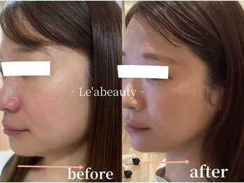 レアビューティー(Le'a beauty)の写真/《小顔を目指したい方、たるみ改善したい方におすすめ◎》結果重視の小顔エステでアナタのお悩み解消へ！
