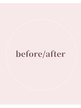 ミミバスト(mimibust)/before after↓