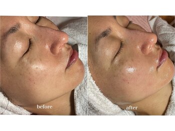 スパークル/フェイシャル/毛穴/しわ予防/