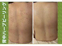 ブレア(Blair)/背中ピーリング