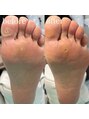 巻き爪補正店 赤羽店&nbsp;足裏のタコや魚の目、お任せください！綺麗に仕上げます☆