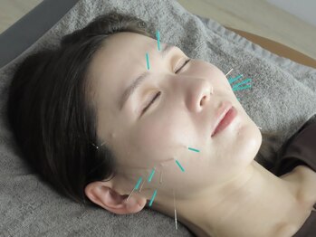 セレス(celes)の写真/本気で変わりたい方必見！美容鍼でお顔の内側から働きかけ、小顔と美肌を実現♪歪みが整い表情も明るく★