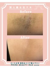 マックス 与野店(MAX)/最新ワキ脱毛☆ビフォアフ