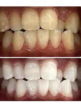 ホワイトニングスタイル 柏店/人気No.1 30分×8来店