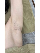 アンビー(Ambee)/脇（わき）メンズ脱毛