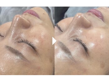 ルミナス(Luminous)の写真/速攻ハリツヤ肌！ララピールで透明感あふれる健やかな肌を育てるエステ☆