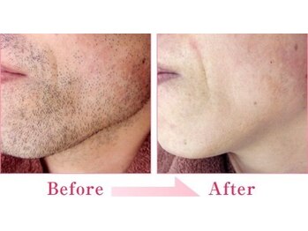 エンドモウ(END MOU)/ツルスベ素肌へ