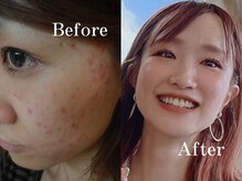 ヨサパーク 指扇店(YOSA PARK)/ お肌の悩みお任せください