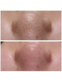 ウォーマル(warmaL)/毛穴エクストラクション