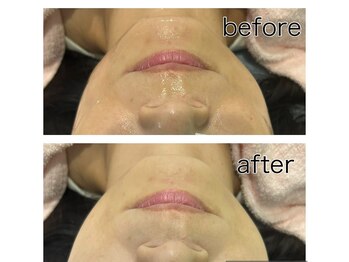 レイモード(Ray mode)/BBLフェイシャルエステ