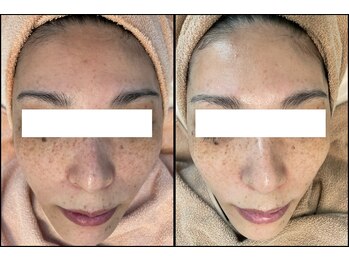 リッツ 草加店(Ritz)/【Before/After】くすみ改善