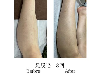 メンズミーシェ(Men's Meshie)/ひざ下脱毛施術前後