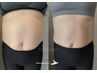 【脂肪燃焼・本気ダイエット】美容溶解トリートメント☆お顔・身体どちらも可