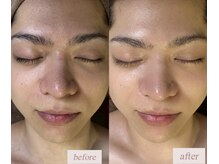 アンドエス 六本木(and S.)/毛穴洗浄＆シミケア《ハイドラ》