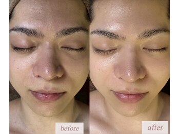 アンドエス 六本木(and S.)/毛穴洗浄&シミケア《ハイドラ》