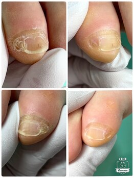 巻き爪補正店 姫路店/副爪→実は角質なんです!