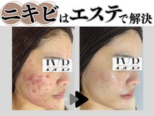 ラヴレボーテ(La Vraie Beaute)の雰囲気（加工なし、当サロンのニキビケア改善症例）