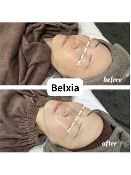 ベルシア(Belxia)/陶肌トリートメント症例