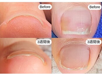 巻き爪ケア