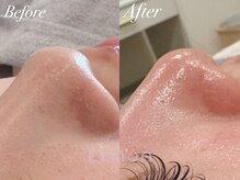 ルノン(Lunon)/毛穴洗浄ハイドロ×ララピール