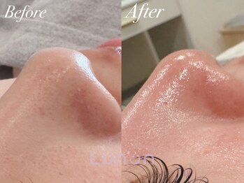 ルノン(Lunon)/毛穴洗浄ハイドロ×ララピール