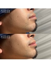 カナウ(KANAU)/ヒゲ脱毛（20代前半男性）