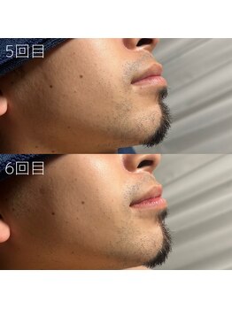 カナウ(KANAU)/ヒゲ脱毛（20代前半男性）