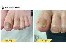 ふっとけ庵/肥厚爪(爪の厚み調整)