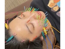 恵比寿すこやか鍼灸整骨院/リフトアップ特化型美容鍼