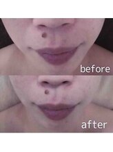 ブランシェ 金沢店 × 椿/シワ・たるみケア　お客様