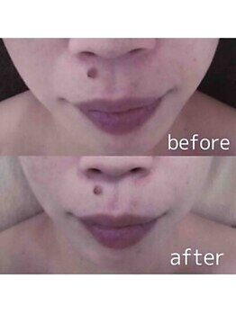 ブランシェ 金沢店 × 椿/シワ・たるみケア　お客様