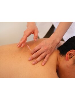 鍼灸施術を受けたい