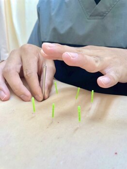 ひめじ鍼灸整骨院の写真/【初めての方にも◎鍼施術】肩こり・腰痛にさよなら☆優しく効果を感じる鍼施術で疲れ知らずへの第一歩に♪