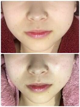 癒しサロン リバースの写真/【韓国肌管理】ハリツヤUPで小顔効果も◎褒められる肌をGETできる♪ワンランク上の水光ピ-リングコ-ス¥8800