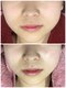 癒しサロン リバースの写真/【韓国肌管理】ハリツヤUPで小顔効果も◎褒められる肌をGETできる♪ワンランク上の水光ピ-リングコ-ス¥8800