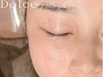 ドルチェ アイ ラッシュ(Dolce)の写真/今話題の【ハイドロ毛穴洗浄】で美しい毛穴レスなお肌を手に入れませんか？【初回¥4,980】