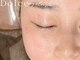 ドルチェ アイ ラッシュ(Dolce)の写真/今話題の【ハイドロ毛穴洗浄】で美しい毛穴レスなお肌を手に入れませんか？【初回¥4,980】