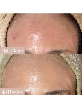 サロン ド エン(Salon de. en)/肌荒れケア◇ハーブピーリング