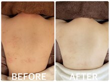 ハーブピーリング 心斎橋/背中ニキビ改善