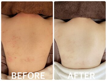 ハーブピーリング 心斎橋/背中ニキビ改善