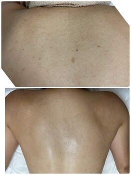 リクラ 北千住(Reclat)/2回ビフォーアフター2回で3万円