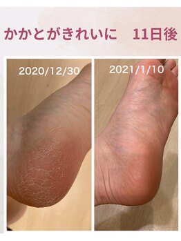 ララスマイル 鶴崎森町店/踵のガサガサが綺麗になりました