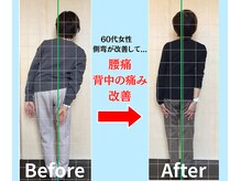 ソヴァール(SAUVEUR)/60代女性の側弯