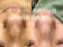 ザ フロウ(THE flow)/敏感肌やニキビにお悩みの方