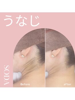 ソーダ(SODA)の写真/うなじや背中自分では難しい部位もワックスや光脱毛で整えて美肌へ！☆