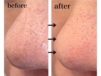 リム(Lim:)/ハイドロ毛穴洗浄◆小顔エステ