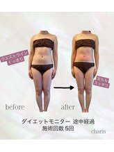 カリス(charis)/施術回数５回