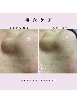 フルーヴ ルフレ(Fleuve Reflet)/☆小鼻のザラザラ改善☆