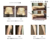 グランツ 小山店の雰囲気（ハイパーナイフの局部的な即効性をぜひ体験してみてください。）